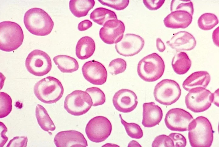 Real peripheral blood smear showing thalassemia target cells